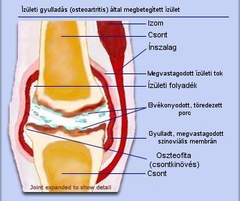 ízületi kezelési üdülőhelyek a csípőízület disztrófikus artrózisa